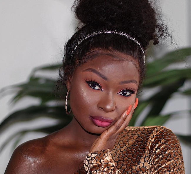 Shalom Blac sempat di-bully karena kulitnya yang penuh dengan luka bakar. Namun ia menemukan kepercayaan diri berkat makeup. Kini ia pun sukses jadi seorang beauty blogger. Foto: Instagram @shalom_blac  