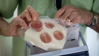 Sejak didirikan, Orbis yang berbasis di Amerika Serikat telah melatih puluhan ribu dokter dan perawat, melakukan jutaan pemeriksaan mata, dan melakukan ribuan operasi mata. Salah saeorang dokter memegang empat kornea donor untuk proses operasi di atas rumah sakit mata melayang. Leon Neal/Getty Images.