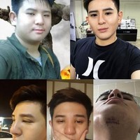 Pria asal Malaysia itu mengaku melakukan operasi kelopak mata, rhinoplasty atau operasi hidung, dan operasi dagu untuk terlihat lebih tampan. Foto: Facebook Steven Yong