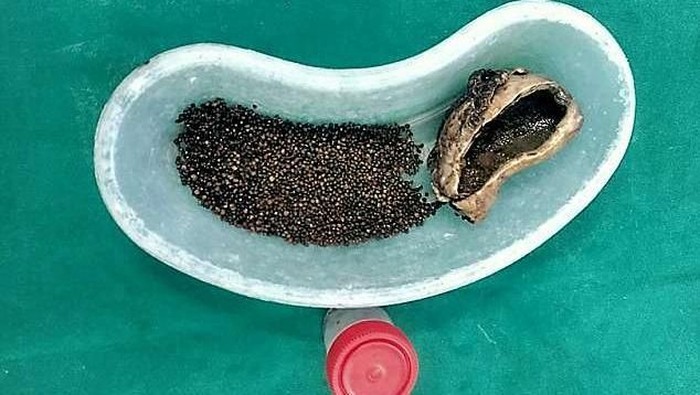 14 Gejala Batu Empedu, Penyebab dan Cara Mengobatinya