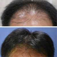 Peneliti Terkejut Ada Metode Yang Cepat Menumbuhkan Rambut