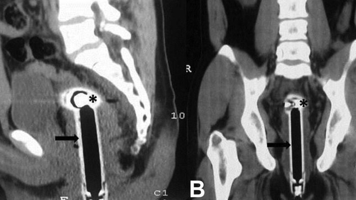 Mengaku Jatuh Saat Mandi, Kepala Shower Terjebak di Anus Sedalam 15 Cm