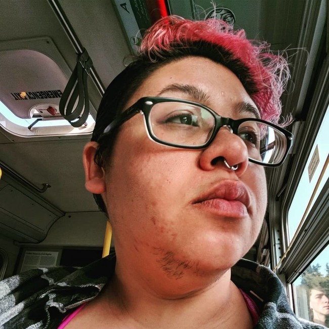 Sama seperti pengalaman wanita lainnya yang tubuhnya ditumbuhi bulu lebar, Adriana Javier pun awalnya merasa sangat tak percaya diri. Namun ada masa-masa di mana ia bisa menerima kondisinya. Saya senang akhirnya saya memiliki keberanian untuk melalui rasa malu dan saya pun bersyukur dengan orang-orang terdekat saya yang memberikan dukungan terbaik untukku, kata Adrian.  Foto: Istimewa