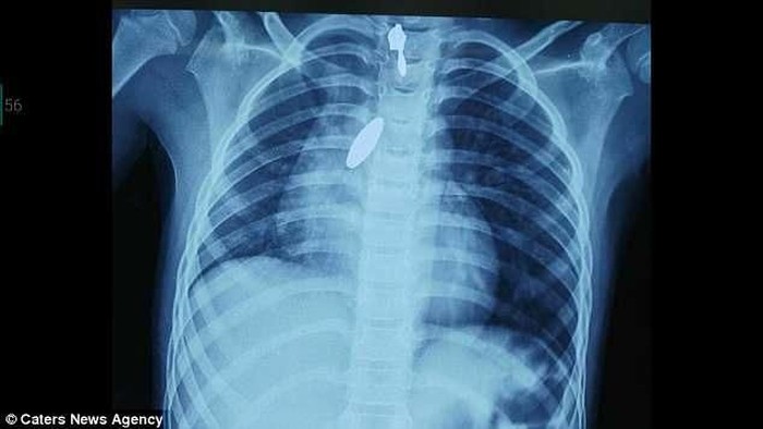 Magnet Masuk ke Paru-Paru, Dokter Gunakan Cara Ini untuk Mengeluarkannya