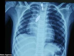 Magnet Masuk ke Paru-Paru, Dokter Gunakan Cara Ini untuk Mengeluarkannya