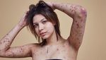 Model Idap Penyakit Kulit Langka Buktikan Cantik Tak Harus Mulus