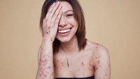 Pada usia 18 bulan, ia terdiagnosis mengidap sebuah kondisi langka yang disebut dengan epidermolysis bullosa. (Foto: Instagram/mbajsb) 