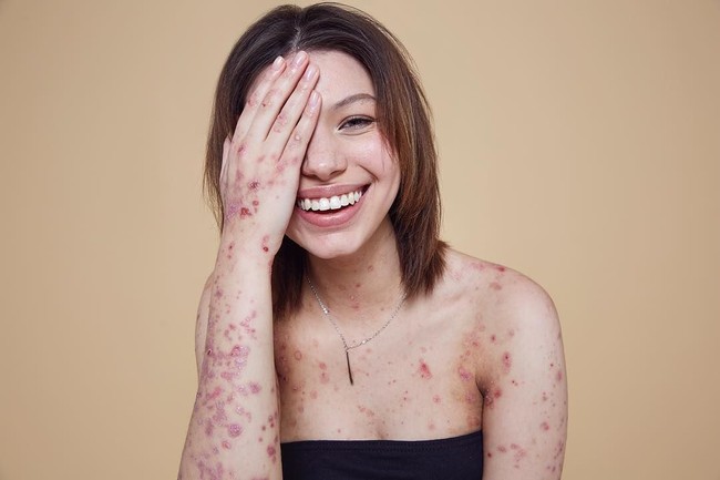 Meski tidak memiliki kulit yang mulus, Maya percaya diri menunjukkan kekurangannya dengan menjadi seorang model. Foto: Instagram Maya Spencer-Berkeley