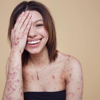 Meski tidak memiliki kulit yang mulus, Maya percaya diri menunjukkan kekurangannya dengan menjadi seorang model. Foto: Instagram Maya Spencer-Berkeley