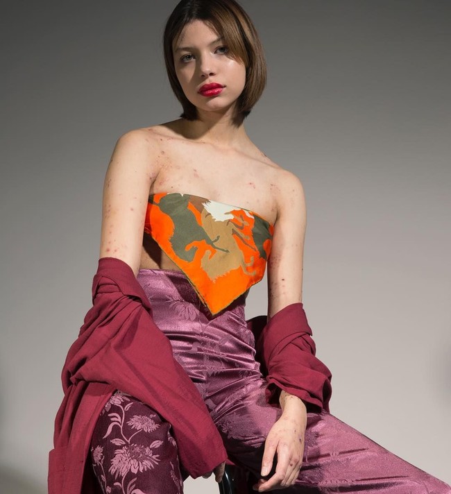 Maya Spencer-Berkeley adalah seorang wanita yang mengalami Epidermolysis Bullosa. Kondisi tersebut membuat kulit tubuhnya dipenuhi dengan luka. Foto: Instagram Maya Spencer-Berkeley