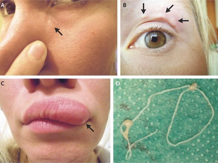 Bentol di wajah yang bergerak-gerak itu ternyata cacing parasit. (Foto: The New England Journal of Medicine) Bentol di wajah yang bergerak-gerak itu ternyata cacing parasit. (Foto: The New England Journal of Medicine)