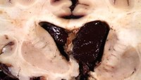 Otak yang mengalami perdarahan karena dinding pembuluh darah membalon akibat ada pelemahan (aneurisma). (Foto: neuropathology-web.org)