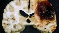 Stroke perdarahan yang terjadi akibat penumpukan protein amiloid di otak. Kondisi ini juga berkaitan erat dengan demensia atau pikun. (Foto: neuropathology-web.org)