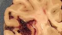 Kadang perdarahan juga bisa terjadi akibat ada malformasi pembuluh darah di otak. Kalau seperti itu gejala yang dirasakan biasanya sakit kepala menahun. (Foto: neuropathology-web.org)