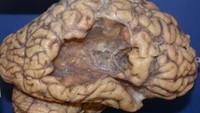 Contoh otak pasien yang selamat dari stroke. Meski dirinya bisa bertahan hidup namun kerusakan sudah terjadi terbukti dari sebagian otak yang hilang. Pasien diketahui meninggal karena sebab lain. (Foto: neuropathology-web.org)