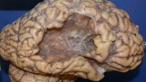 Mau Tahu Seperti Apa Otak yang Kena Stroke? Begini Penampakannya