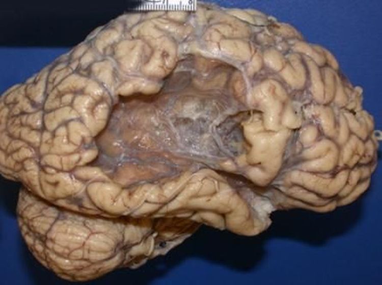 Mau Tahu Seperti Apa Otak yang Kena Stroke? Begini Penampakannya