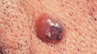 Basal-cell carcinoma (BCC) merupakan jenis kanker kulit yang paling umum. Bentuknya bisa beragam namun ciri khasnya adalah seperti bentol merah yang kadang luka. (Foto: Skin Cancer Foundation)
