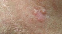 Kondisi bernama actinic keratosis memiliki ciri-ciri kulit yang kasar dan bersisik karena paparan sinar matahari. Kondisi ini bila dibiarkan bisa berkembang menjadi kanker terutama SCC. (Foto: Skin Cancer Foundation)