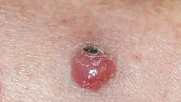 Merkel cell carcinoma (MCC) adalah bentuk kanker kulit yang langka disebabkan oleh virus. Bentuknya seperti kista atau bentol biasa sehingga memang sulit untuk dibedakan. (Foto: Skin Cancer Foundation)