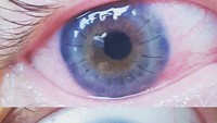 Mata pasien ini berubah warna setelah transplantasi dari biru menjadi coklat. (Foto: Internet)