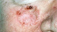 Squamous cell carcinoma (SCC) merupakan kanker kulit kedua paling umum setelah BCC. Ciri khasnya adalah kulit yang terlihat seperti bersisik merah dan kadang juga berdarah. (Foto: Skin Cancer Foundation)