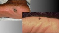 Ini adalah contoh melanoma amelanotic. Bedanya dengan melanoma biasa adalah kulitnya tidak memproduksi melanin sehingga bisa terlihat seperti kulit sehat sehingga sulit diidentifikasi bahkan oleh dokter. (Foto: Skin Cancer Foundation)