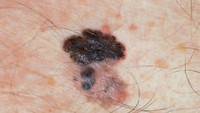 Melanoma adalah jenis kanker kulit yang paling ganas. Sekilas terlihat seperti tahi lalat namun melanoma bentuknya tidak bulat simetris dan bisa memiliki warna yang tidak seragam. (Foto: Skin Cancer Foundation)