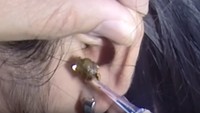 Wah, besar ya kotoran telinganya. (Foto: YouTube)