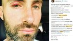 Adam Levine Lagi Bintitan, Tetap Ganteng?