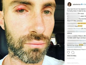 Adam Levine Bintitan, Masih Ganteng Nggak?