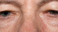 Pelupuk mata melorot bisa jadi salah satu tanda dari penyakit myasthenia gravis yang membuat sistem imun menyerang dan melemahkan otot. (Foto: WebMD)