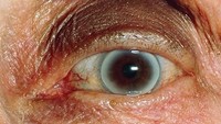 Cincin di kornea mata atau corneal acus biasanya berwarna putih-abu yang merupakan sisa lemak. Umum terjadi para lansia, namun jika terjadi pada anak muda bisa jadi tanda kolesterol tinggi. (Foto: WebMD)