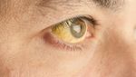 Foto: Ragam Masalah Kesehatan yang Bisa Diketahui dari Mata
