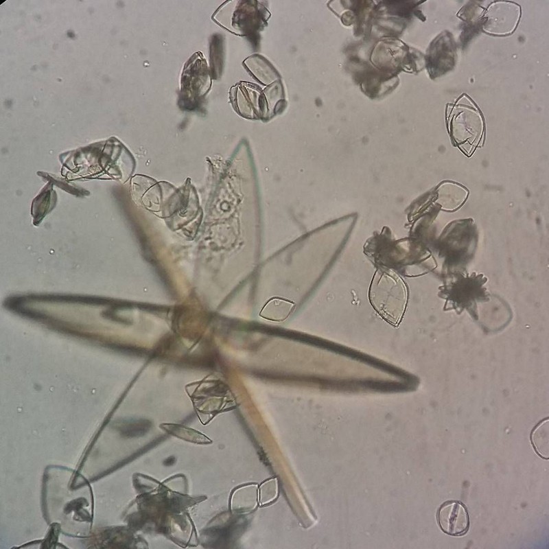 Akumulasi purin dalam kadar yang tinggi dalam tubuh bisa mengarah pada pengkristalan. Kristal cantik berbahaya itu dapat dilihat dari bawah lensa mikroskop.