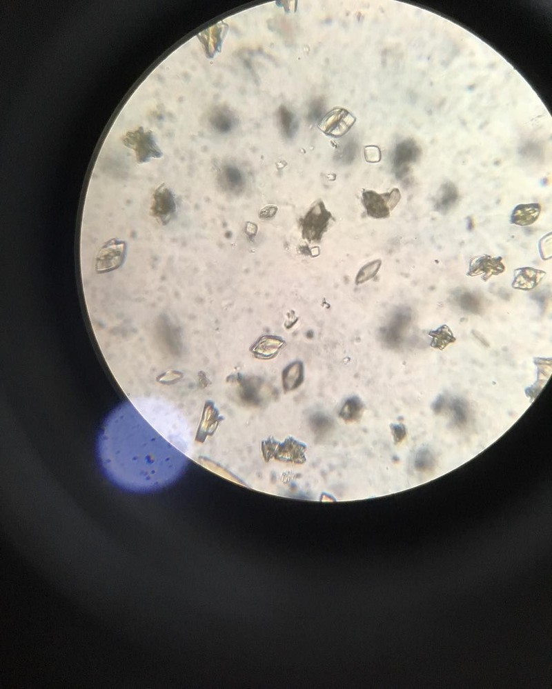 Akumulasi purin dalam kadar yang tinggi dalam tubuh bisa mengarah pada pengkristalan. Kristal cantik berbahaya itu dapat dilihat dari bawah lensa mikroskop.