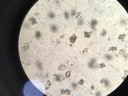 Cantik Tapi Mengerikan, Kristal Asam Urat di Bawah Lensa Mikroskop