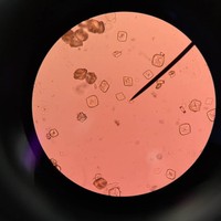 Akumulasi purin dalam kadar yang tinggi dalam tubuh bisa mengarah pada pengkristalan. Kristal cantik berbahaya itu dapat dilihat dari bawah lensa mikroskop.