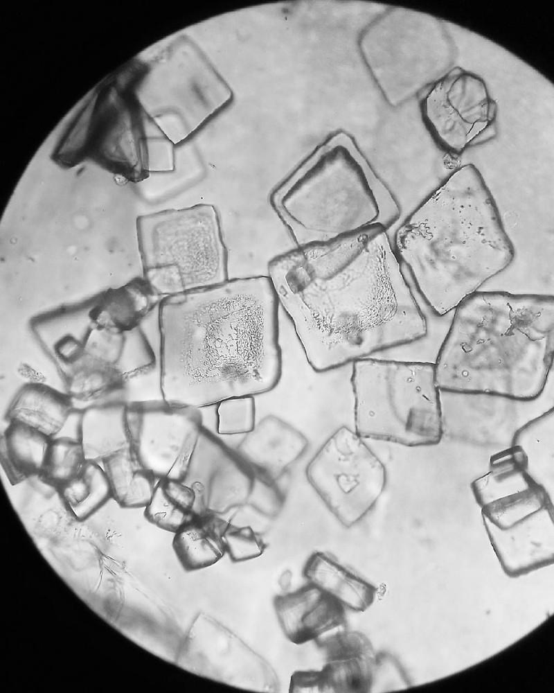 Akumulasi purin dalam kadar yang tinggi dalam tubuh bisa mengarah pada pengkristalan. Kristal cantik berbahaya itu dapat dilihat dari bawah lensa mikroskop.