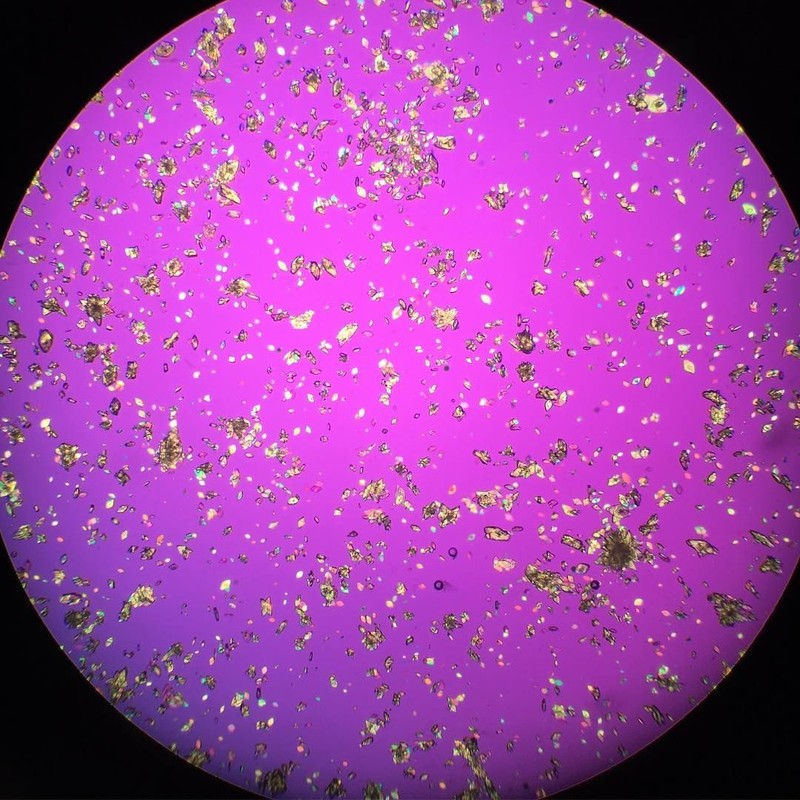 Akumulasi purin dalam kadar yang tinggi dalam tubuh bisa mengarah pada pengkristalan. Kristal cantik berbahaya itu dapat dilihat dari bawah lensa mikroskop.