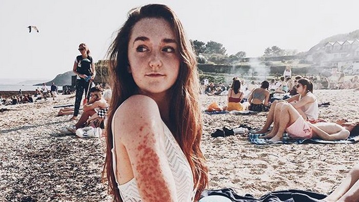 Charlotte didiagnosis psoriasis, yaitu penyakit peradangan kronis dengan kondisi kulit yang memerah dan nampak bersisik akibat reaksi autoimun/Foto: Instagram/itsonlypsoriasis Charlotte didiagnosis psoriasis, yaitu penyakit peradangan kronis dengan kondisi kulit yang memerah dan nampak bersisik akibat reaksi autoimun/Foto: Instagram/itsonlypsoriasis