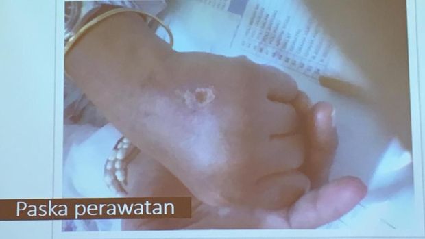 Terobosan Baru pada Terapi Kanker Payudara, Lebih Cepat dan Efisien