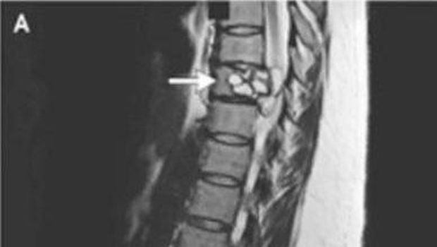 Cacing pita di tulang belakang 