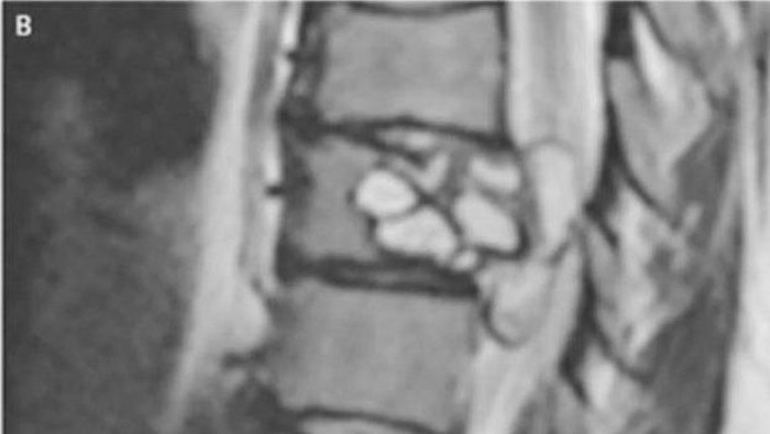 Pernah merasa geli di bagian kaki dan betis? Wanita asal Prancis ini mengalaminya, yang ternyata disebabkan oleh larva cacing pita yang ada di tulang belakang. Foto: The New England Journal of Medicine Pernah merasa geli di bagian kaki dan betis? Wanita asal Prancis ini mengalaminya, yang ternyata disebabkan oleh larva cacing pita yang ada di tulang belakang. Foto: The New England Journal of Medicine