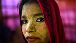 Foto: Gadis Rohingya yang Kuning Wajahnya