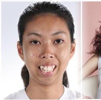  Sebelumnya, penampilan Jitraporn dianggap tak menarik. Susunan giginya yang tak rata membuat bibir Jitraporn sulit menutup. Selain itu bentuk wajahnya yang bulat pun membuat dirinya tak percaya diri. Foto: Instagram