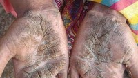 Keratin adalah protein yang menyusun lapisan kulit paling luar. Para penyandang epidermolytic hyperkeratosis tubuhnya diketahui memiliki pertumbuhan kulit tidak terkendali. (Foto: Facebook)