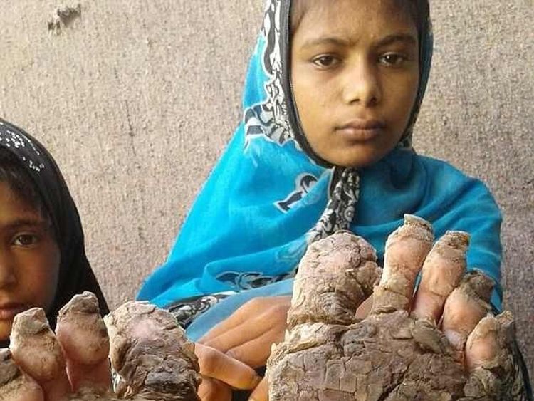 4 Bersaudara yang Tangan Kakinya Membatu Akibat Penyakit Langka