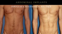 Satu dokter bedah plastik di New York, Douglas Steinbrech, menunjukkan bagaimana perut yang mendapatkan implan bisa berubah jadi sixpack. (Foto: instagram/maleplasticsurgery)