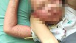 Foto: Contoh Memar dan Ruam yang Bisa Jadi Tanda Kanker Darah Leukemia